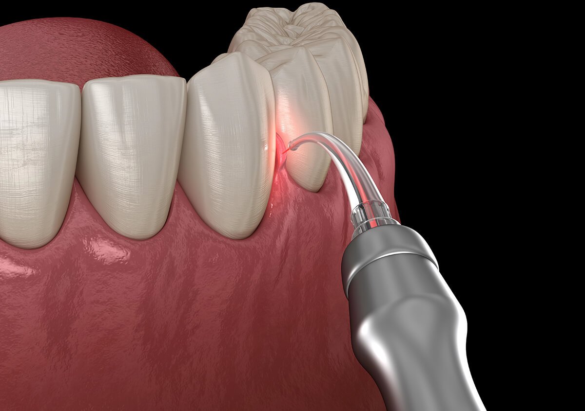 How Does Gum Disease Treatment with Laser Dentistry Work?