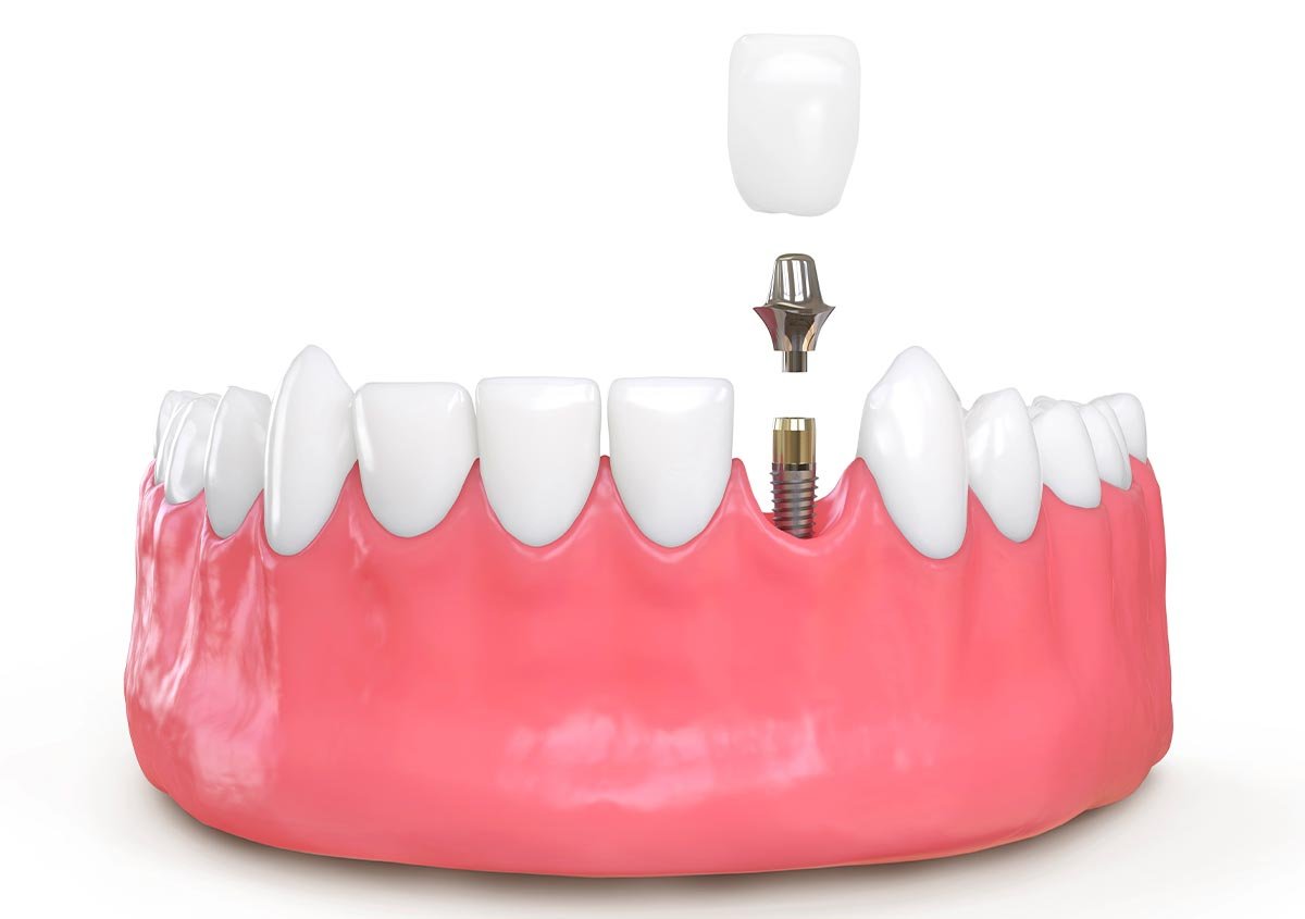 Commonly asked questions about implantation dentistry for teeth replacement.